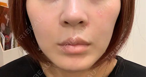 美容点滴・美容注射（美肌） / ヒアルロン酸注入（鼻翼基部） ヴェリテクリニック 大阪院 DAY 0 メイン用