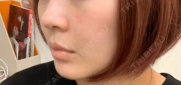 美容点滴・美容注射（美肌） / ヒアルロン酸注入（鼻翼基部） ヴェリテクリニック 大阪院 DAY 0 メイン用