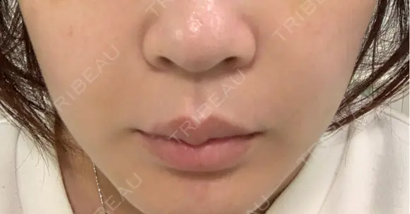 美容点滴・美容注射（美肌） / ヒアルロン酸注入（鼻翼基部） ヴェリテクリニック 大阪院 AFTER メイン用