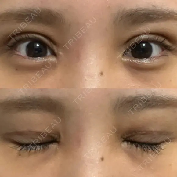 二重切開 / 目頭切開 オーキッド美容クリニック東京御徒町 DAY 12 メイン用