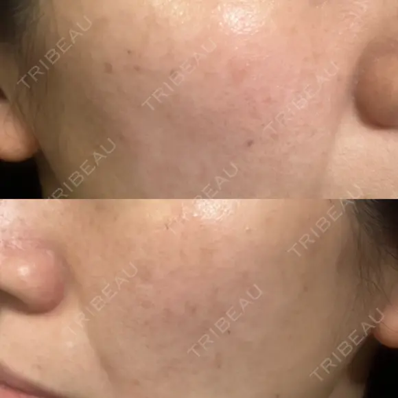 光治療（フォトフェイシャルなど） 小木曽クリニック DAY 4 メイン用