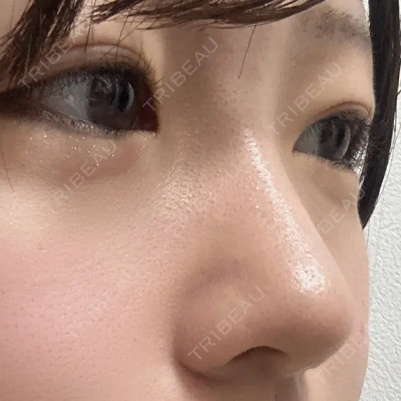 小鼻縮小（切開） / 鼻尖形成（非切開） ASTRA BEAUTY CLINIC AFTER メイン用