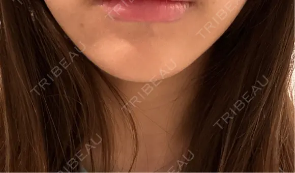 ボトックス（あご） / ボトックス（目尻） 東京美容医療クリニック 池袋院 AFTER メイン用