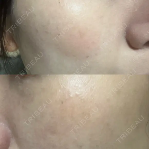 光治療（フォトフェイシャルなど） 小木曽クリニック DAY 5 メイン用