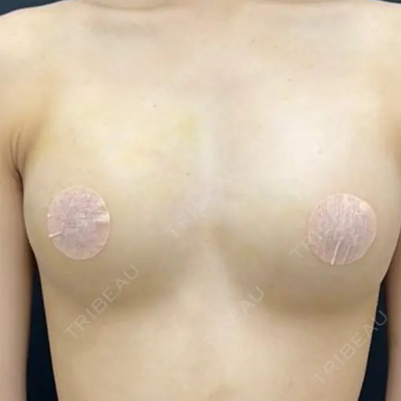 豊胸（脂肪注入） 湘南美容クリニック 吉祥寺院 DAY 7 メイン用