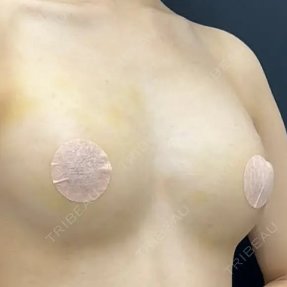 豊胸（脂肪注入） 湘南美容クリニック 吉祥寺院 DAY 7 メイン用