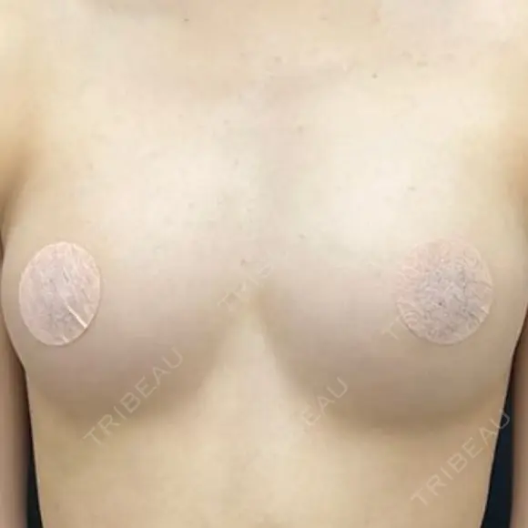豊胸（脂肪注入） 湘南美容クリニック 吉祥寺院 AFTER メイン用