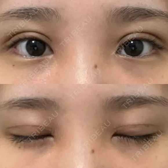 二重切開 / 目頭切開 オーキッド美容クリニック東京御徒町 DAY 14 メイン用