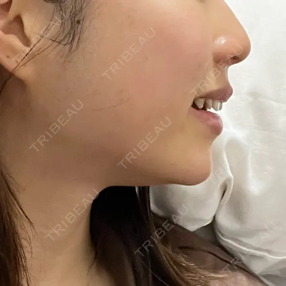 ヒアルロン酸注入（あご） ヴェリテクリニック 大阪院 AFTER メイン用