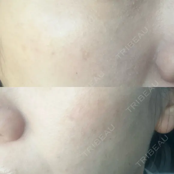 光治療（フォトフェイシャルなど） 小木曽クリニック DAY 6 メイン用