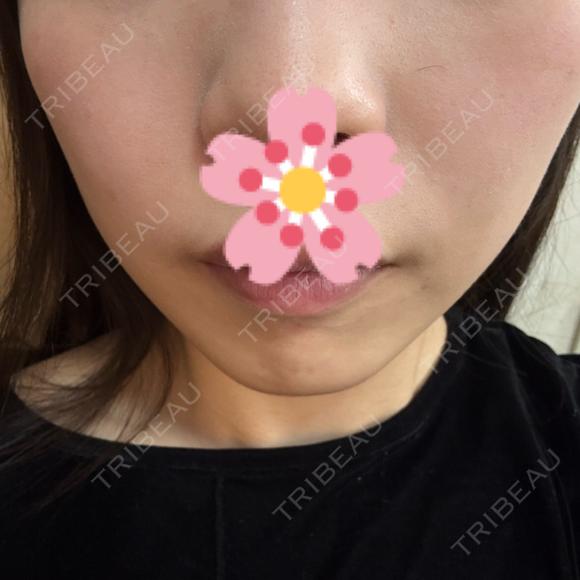ハイフ（顔） しんゆり美容健康クリニック DAY 0 メイン用