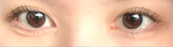 二重切開 / 目頭切開 / 目尻切開 EMMA CLINIC（エマクリニック） AFTER メイン用