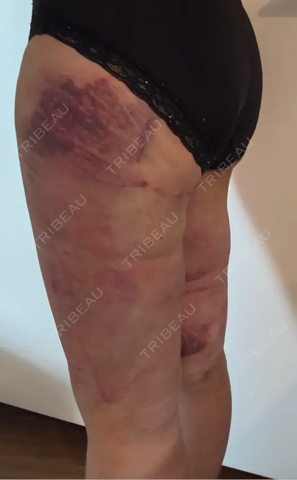 脂肪吸引（脚） アムルーズ美容外科クリニック 横浜院 DAY 1 メイン用