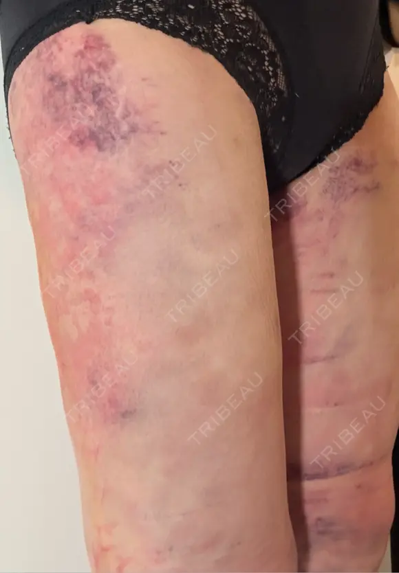 脂肪吸引（脚） アムルーズ美容外科クリニック 横浜院 DAY 1 メイン用