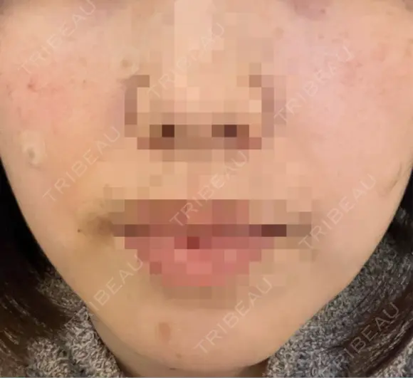 ほくろ・いぼ切除（肌） KARIS beauty clinic DAY 5 メイン用