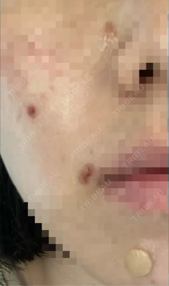 ほくろ・いぼ切除（肌） KARIS beauty clinic DAY 4 メイン用