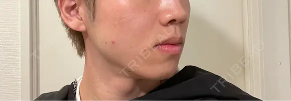 ボトックス（エラ・小顔） / ヒアルロン酸注入（鼻翼基部） KAGA CLINIC DAY 9 メイン用