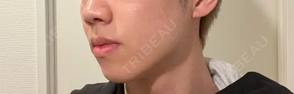 ボトックス（エラ・小顔） / ヒアルロン酸注入（鼻翼基部） KAGA CLINIC DAY 9 メイン用