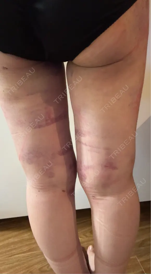 脂肪吸引（脚） アムルーズ美容外科クリニック 横浜院 DAY 2 メイン用