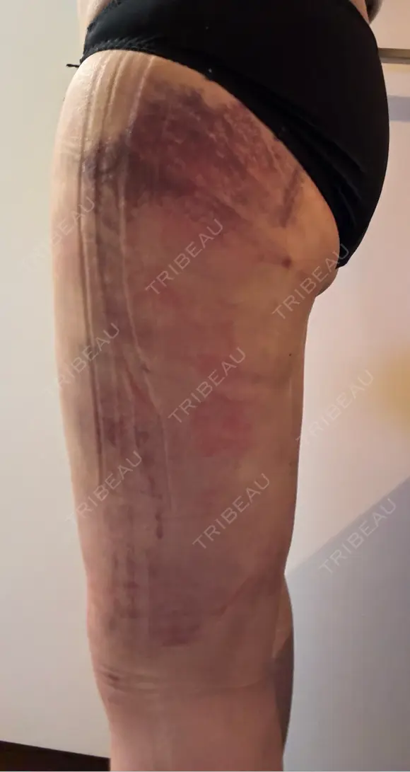 脂肪吸引（脚） アムルーズ美容外科クリニック 横浜院 DAY 2 メイン用