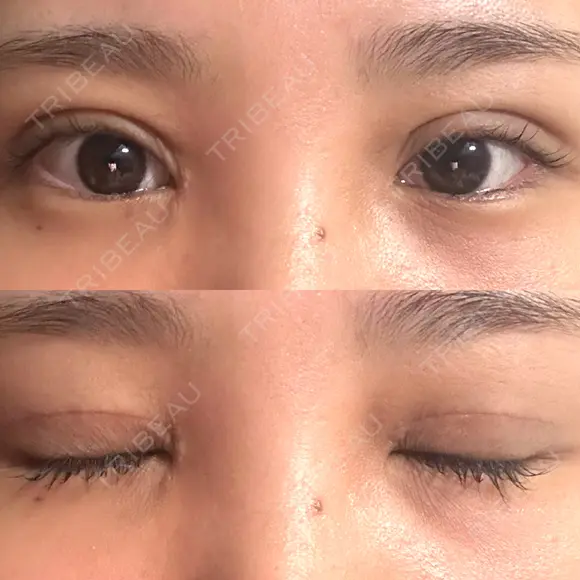 二重切開 / 目頭切開 オーキッド美容クリニック東京御徒町 DAY 15 メイン用