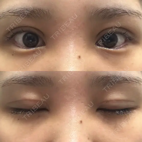 二重切開 / 目頭切開 オーキッド美容クリニック東京御徒町 DAY 16 メイン用