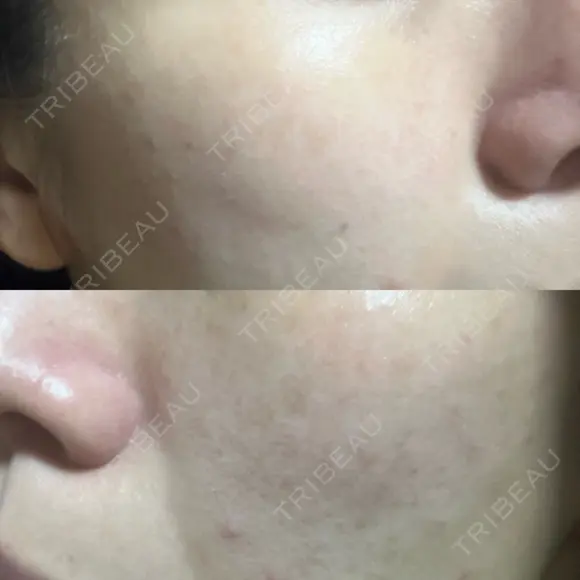 光治療（フォトフェイシャルなど） 小木曽クリニック DAY 8 メイン用