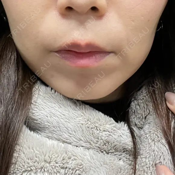 ハイフ（顔） 新宿中央クリニック DAY 8 メイン用