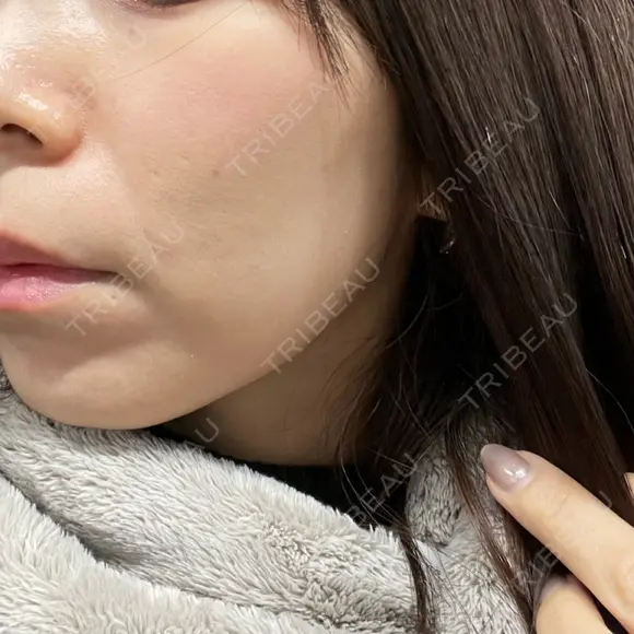 ハイフ（顔） 新宿中央クリニック DAY 8 メイン用