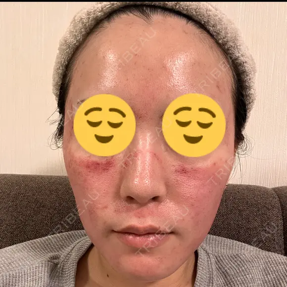 ダーマペン 美容皮膚科 デュークリニック DAY 1 メイン用