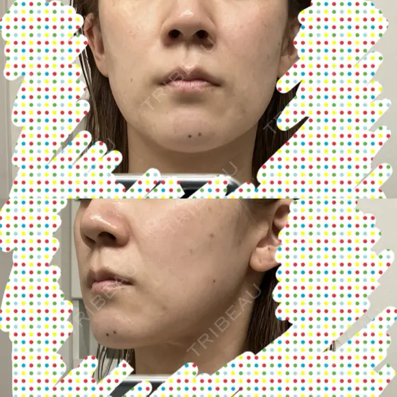 ヒアルロン酸注入（頬） / サーマクール 湘南美容クリニック 仙台院 DAY 2 メイン用