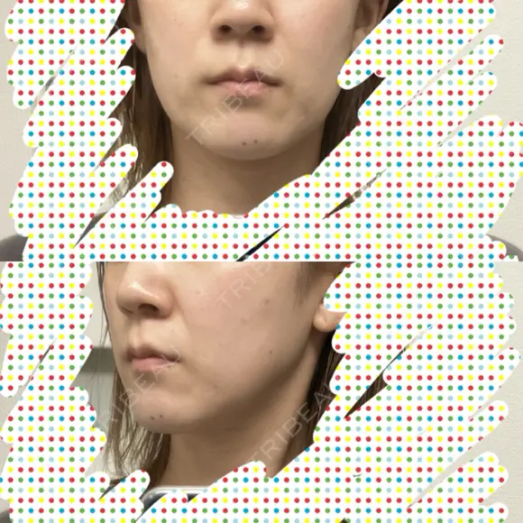 ヒアルロン酸注入（頬） / サーマクール 湘南美容クリニック 仙台院 AFTER メイン用