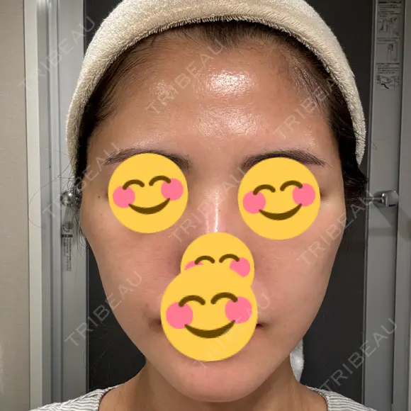 切開リフト 東京エビスクリニック AFTER メイン用