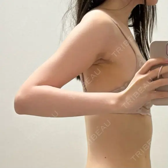 脂肪吸引（二の腕） 湘南美容クリニック 大阪なんば院 AFTER メイン用