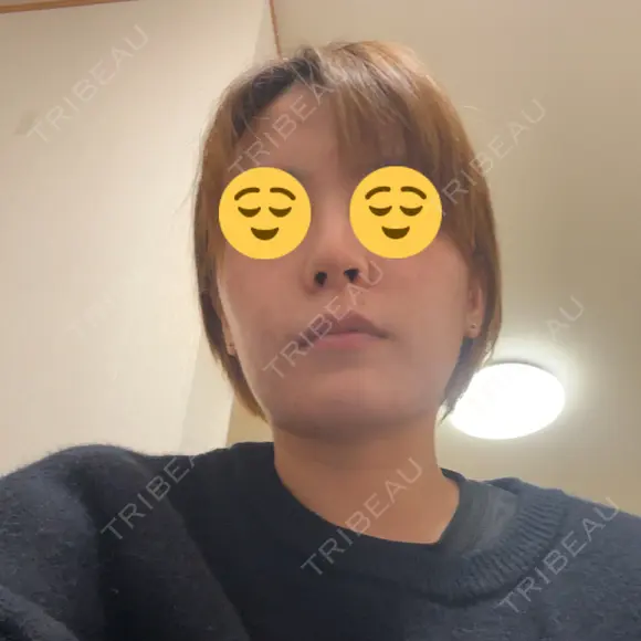 ダーマペン 美容皮膚科 デュークリニック AFTER メイン用