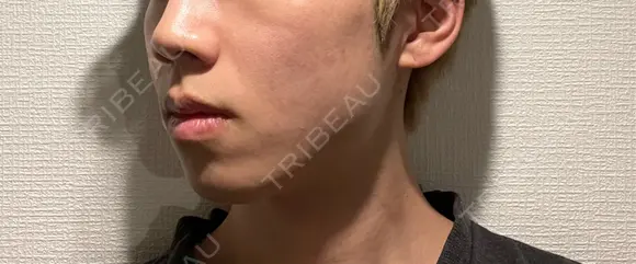 ボトックス（エラ・小顔） / ヒアルロン酸注入（鼻翼基部） KAGA CLINIC DAY 12 メイン用