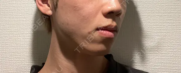 ボトックス（エラ・小顔） / ヒアルロン酸注入（鼻翼基部） KAGA CLINIC DAY 12 メイン用