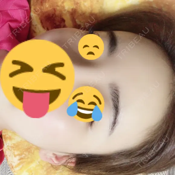 脂肪吸引（顔） / 額を丸く / 脂肪吸引（脚） / こめかみ形成 / 輪郭修正 / 脂肪注入（額） / 脂肪注入（輪郭） フレッシュ整形外科 DAY 69 メイン用