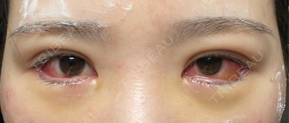 二重埋没 / タレ目形成・グラマラスライン（切開） エターナル美容クリニック DAY 6 メイン用