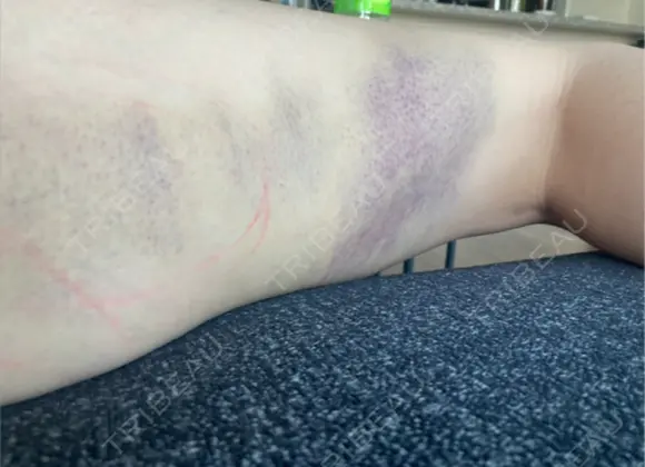 脂肪吸引（脚） 銀座マイアミ美容外科 DAY 7 メイン用