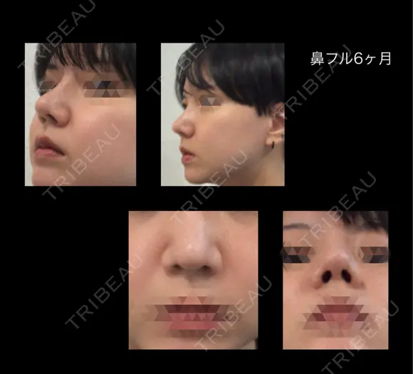 隆鼻術 / 鼻尖形成（切開） / 鼻中隔延長（切開） / 骨切幅寄せ / ワシ鼻修正・ハンプ切除 LUHO（ルホ）美容外科 AFTER メイン用