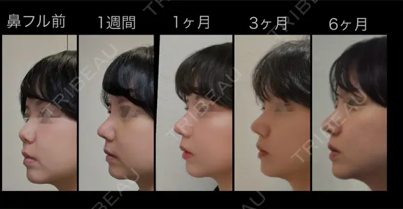 隆鼻術 / 鼻尖形成（切開） / 鼻中隔延長（切開） / 骨切幅寄せ / ワシ鼻修正・ハンプ切除 LUHO（ルホ）美容外科 DAY 180 メイン用