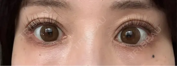 タレ目形成・グラマラスライン（切開） アネシス美容クリニック AFTER メイン用