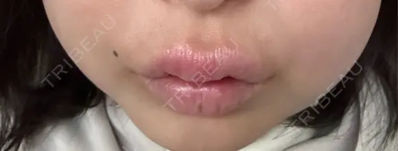 その他（口元） アネシス美容クリニック AFTER メイン用