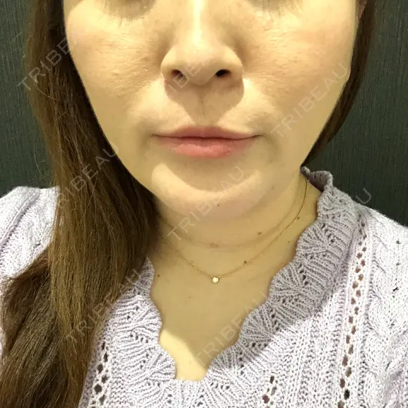 バッカルファット除去 / 脂肪吸引（顔） 湘南美容クリニック 秋葉原院 DAY 200 メイン用