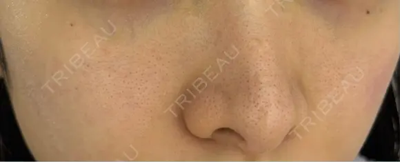 マイクロボトックス lime clinic （杏クリニック） AFTER メイン用