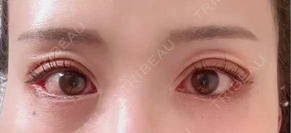 タレ目形成・グラマラスライン（切開） アネシス美容クリニック DAY 7 メイン用