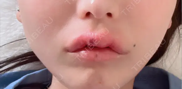 その他（口元） アネシス美容クリニック DAY 7 メイン用