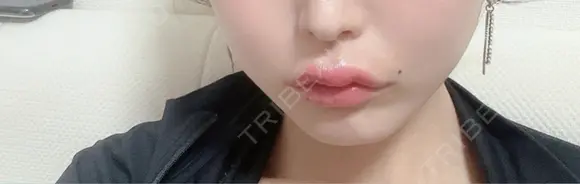 その他（口元） アネシス美容クリニック DAY 25 メイン用