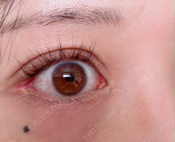 タレ目形成・グラマラスライン（切開） アネシス美容クリニック DAY 54 メイン用